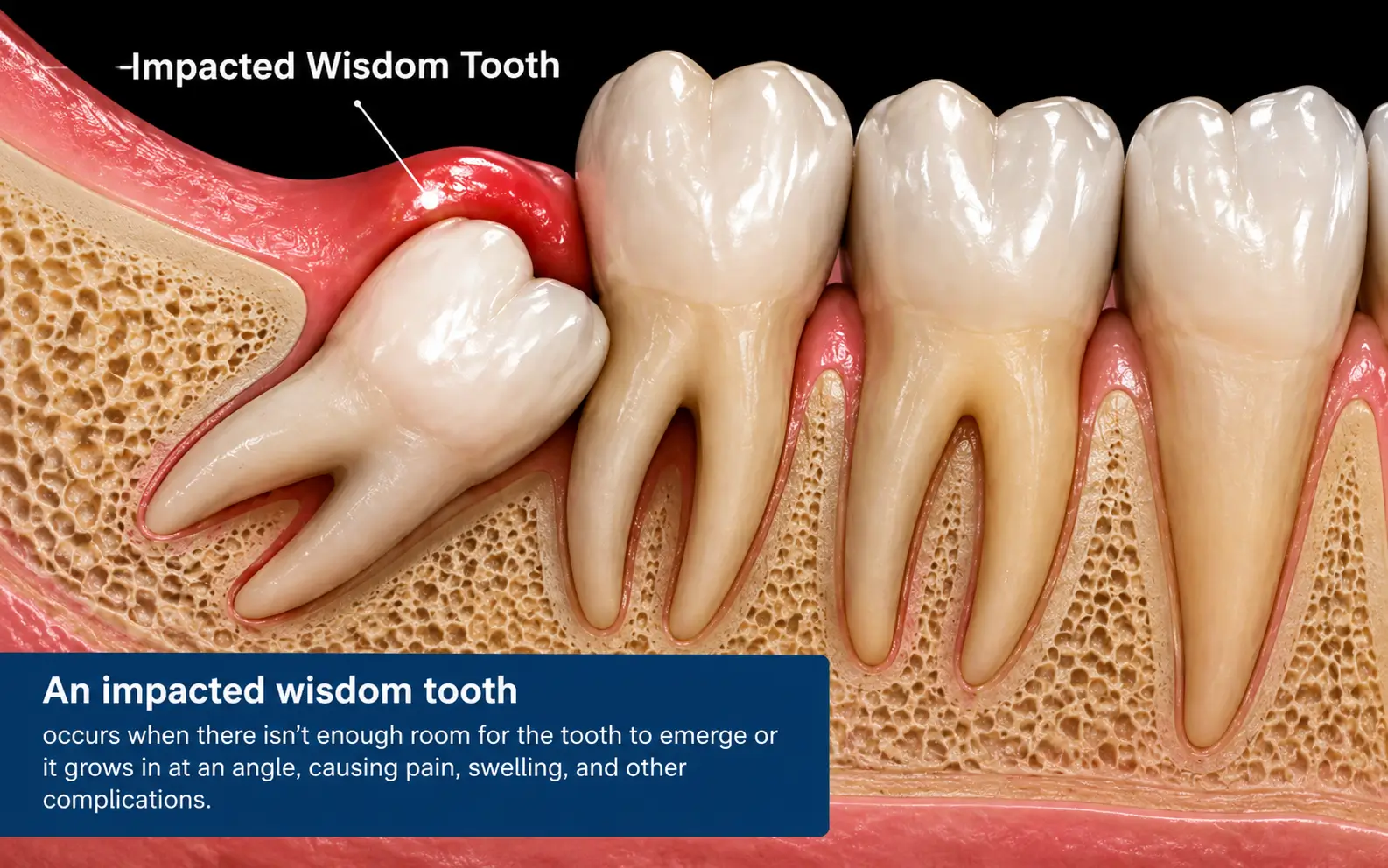 Impacted Wisdom Teeth